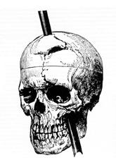 Phineas Gage Kafatası ve Tamping Demiri